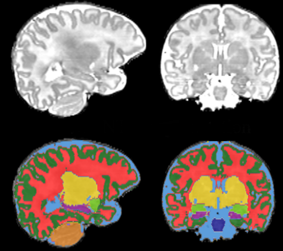 Neuroimaging